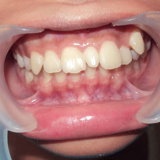  Что такое сверхкомплектный зуб?